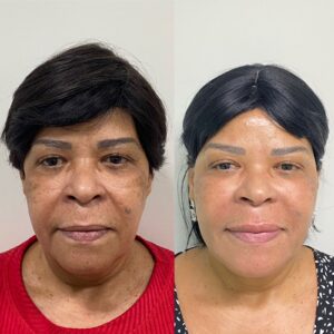 HOF Harmonização orofacial Salvador
