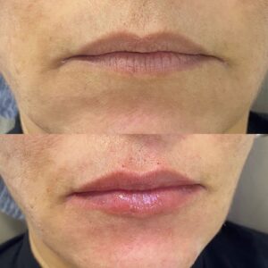 HOF Harmonização orofacial Salvador