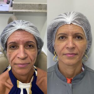 HOF HARMONIZAÇÃO OROFACIAL
