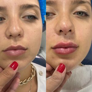 HOF PREENCHIMENTO LABIAL
