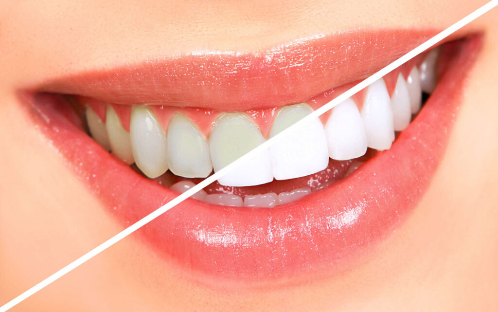 Transforme seu sorriso com lentes de contato dental no HOE. Procedimento estético seguro e eficiente para um sorriso mais branco e harmônico. Agende sua consulta.