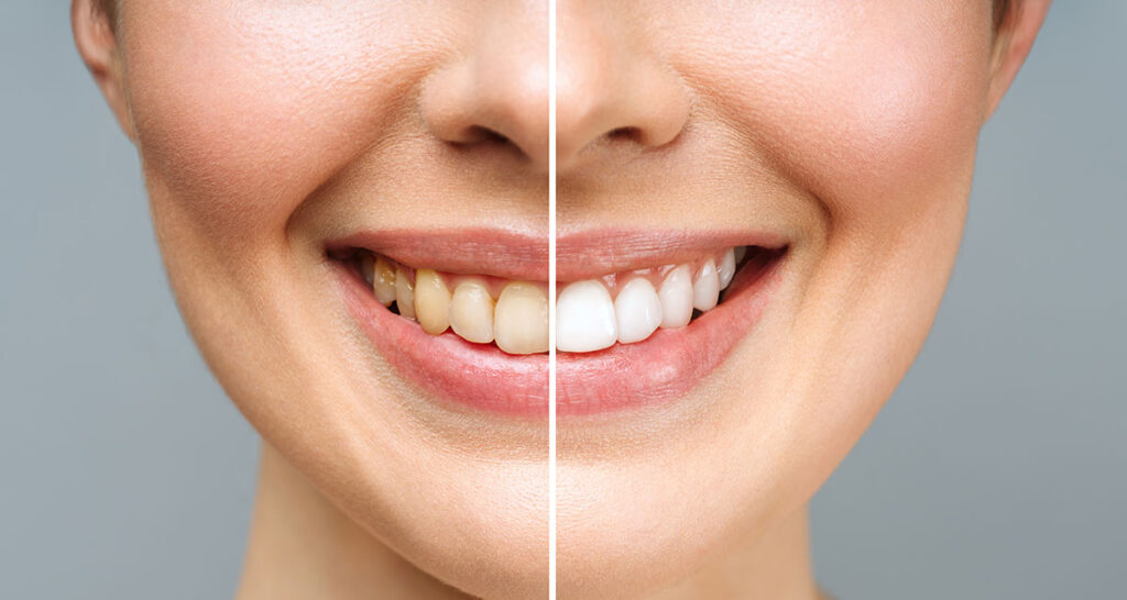 Descubra o clareamento dental no HOE e tenha um sorriso mais branco e saudável com técnicas seguras e eficazes. Agende sua avaliação e transforme seu sorriso.