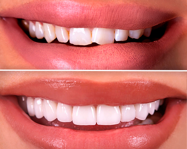 Imagem mostrando antes e depois de correções estéticas dentárias.