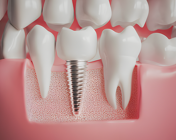 Imagem comparativa ilustrando as diferenças entre implantes e próteses dentárias, demonstrando claramente as diferenças entre os tratamentos.