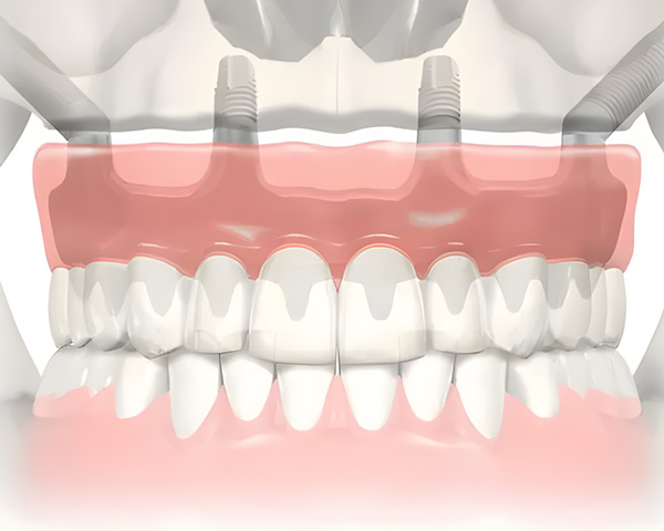 Imagem ilustrativa de uma cirurgia de implante zigomático, mostrando a fixação do implante no osso zigomático em paciente com perda óssea severa.
