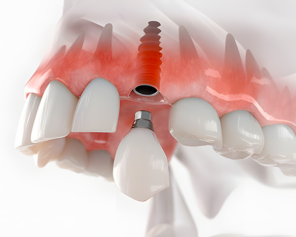 Imagem ilustrativa de uma cirurgia de implante zigomático, mostrando a fixação do implante no osso zigomático em paciente com perda óssea severa.