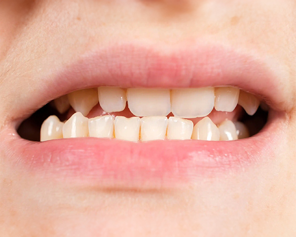 Ilustração de um paciente com mordida cruzada entre as arcadas dentárias superior e inferior.