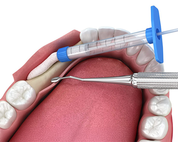 Imagem ilustrativa de enxerto ósseo dentário sendo aplicado antes de um implante