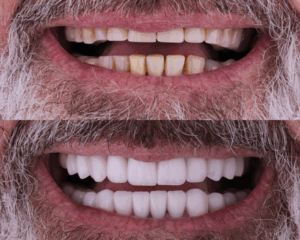 Comparativo entre dentes com facetas de resina e dentes com facetas de porcelana, mostrando a diferença na estética e brilho.