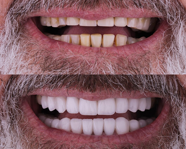 Comparativo entre dentes com facetas de resina e dentes com facetas de porcelana, mostrando a diferença na estética e brilho.