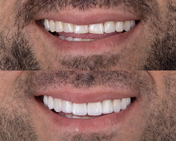 Comparativo entre dentes com facetas de resina e dentes com facetas de porcelana, mostrando a diferença na estética e brilho.