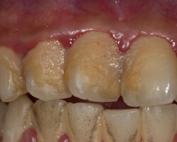 Close em dentes com acúmulo de placa e tártaro na região superior e inferior, ilustrando a necessidade de limpeza dentária profissional.