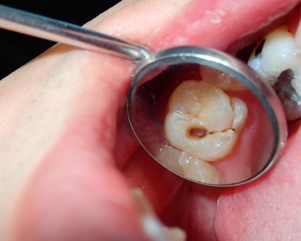 Espelho odontológico mostrando dente com cárie e acúmulo de resíduos, evidenciando a necessidade de limpeza dentária e tratamento profissional.