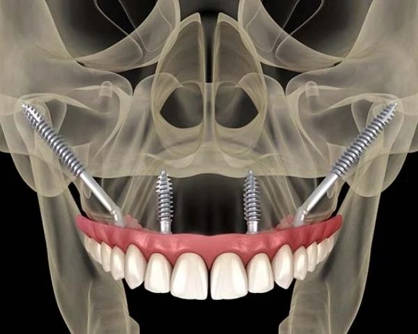 Imagem ilustrativa com implantes zigomáticos fixados no osso facial, exemplificando quando implante zigomático é indicado em casos de perda óssea.