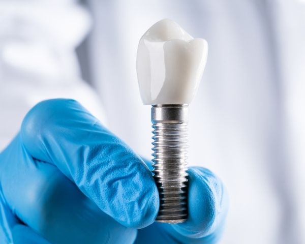 Profissional segurando modelo de implante dentário com luva, representando o procedimento e os componentes do implante dentário.