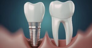 Ilustração comparando dente natural e implante dentário fixado no osso, demonstrando estrutura e funcionamento do implante dentário.