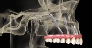 Ilustração de prótese fixa com implantes zigomáticos, mostrando quando implante zigomático é indicado para pacientes com perda óssea severa.