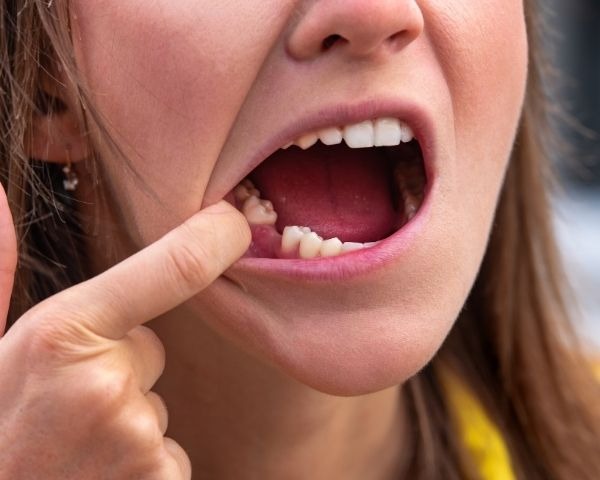 A falta de dentes pode afetar a saúde de todo o corpo: digestão, nutrição, perda óssea, problemas na ATM e envelhecimento facial. Não é só estética.
